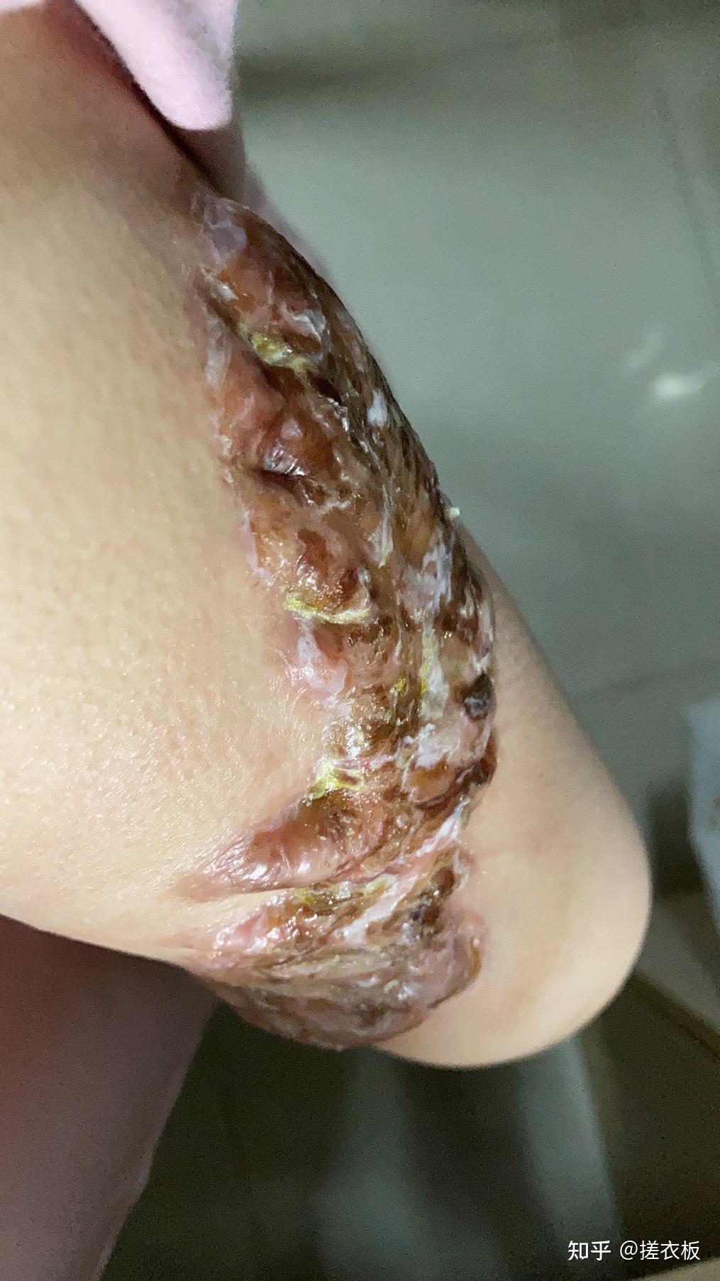 瘢痕体质的人这一生有什么样的体验