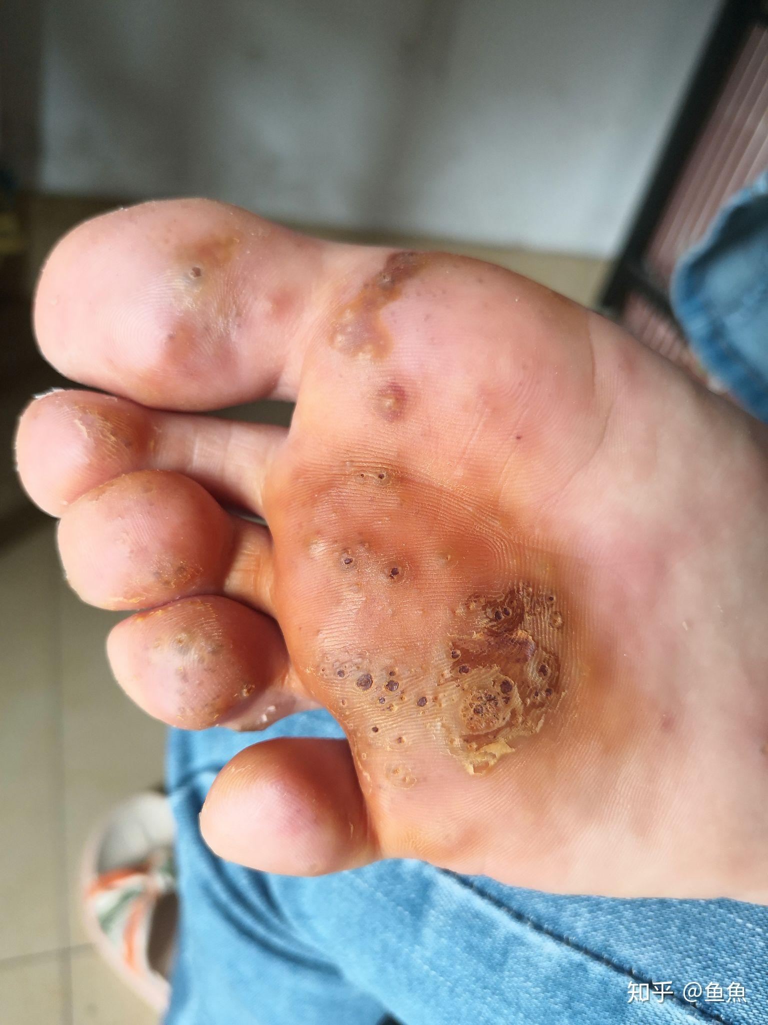 跖疣的自愈性大吗? - 知乎