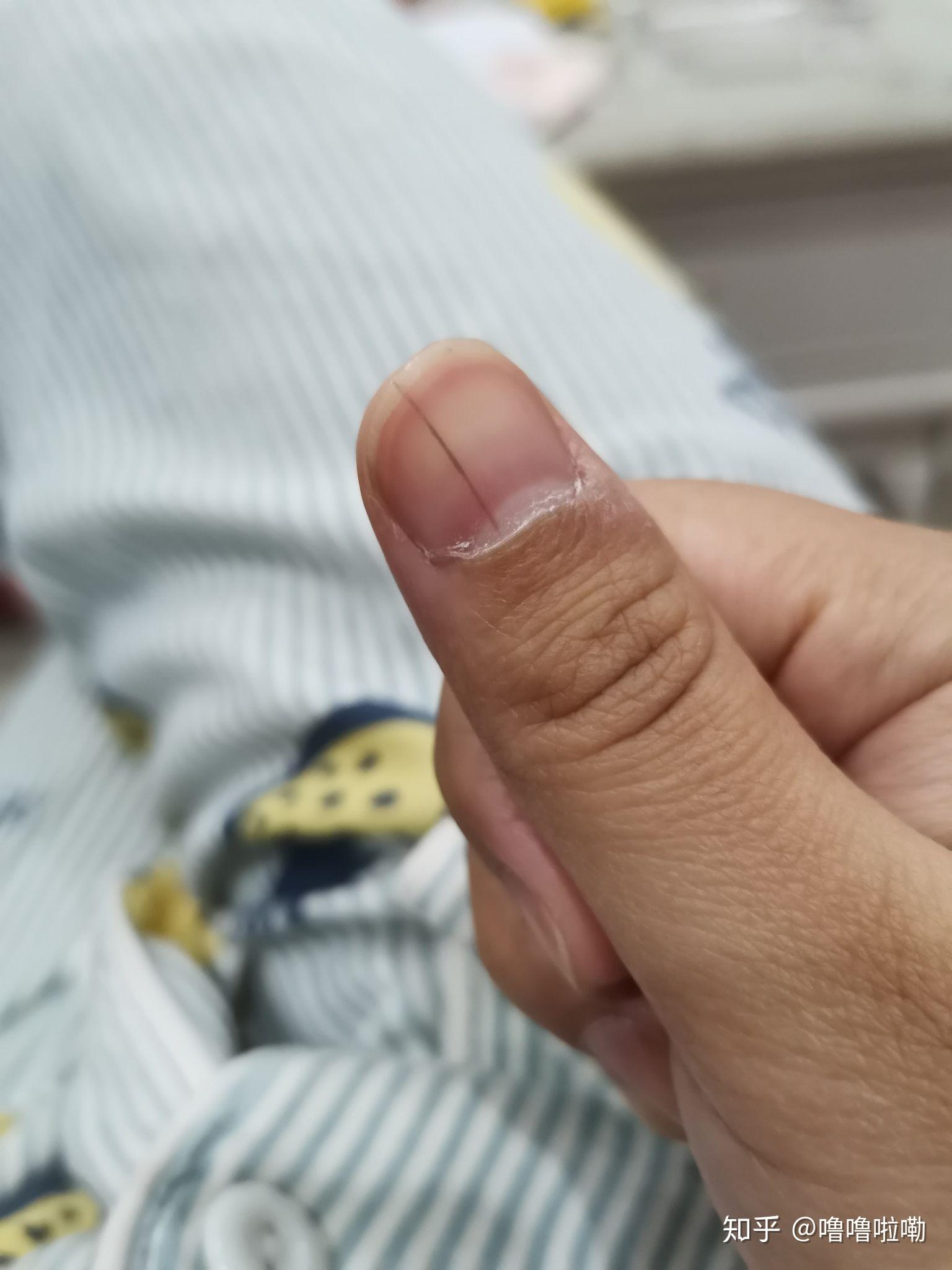 左手大拇指指甲出现一条黑色竖纹,是怎么回事? 