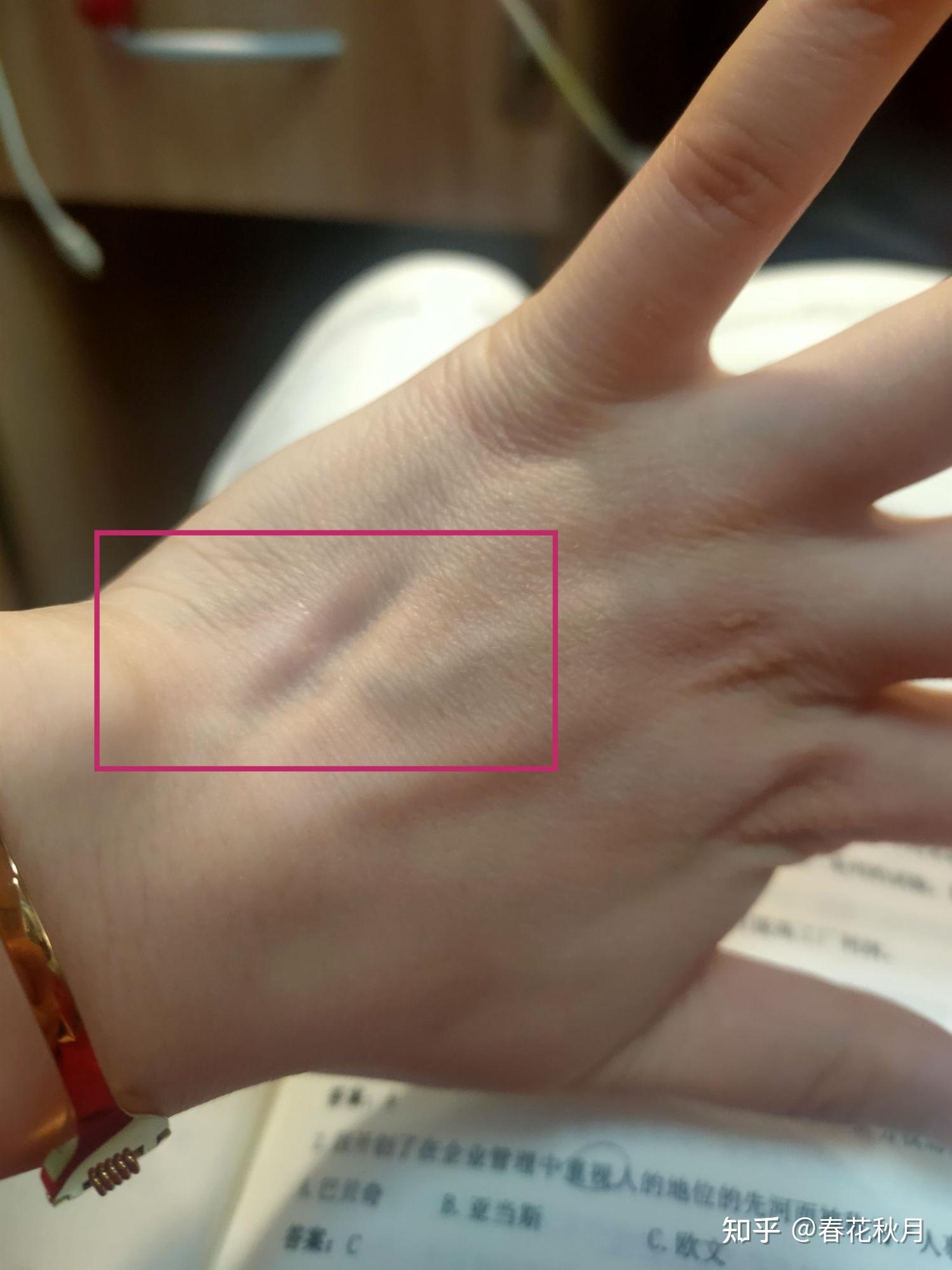 手背处向内凹陷是什么病? - 知乎