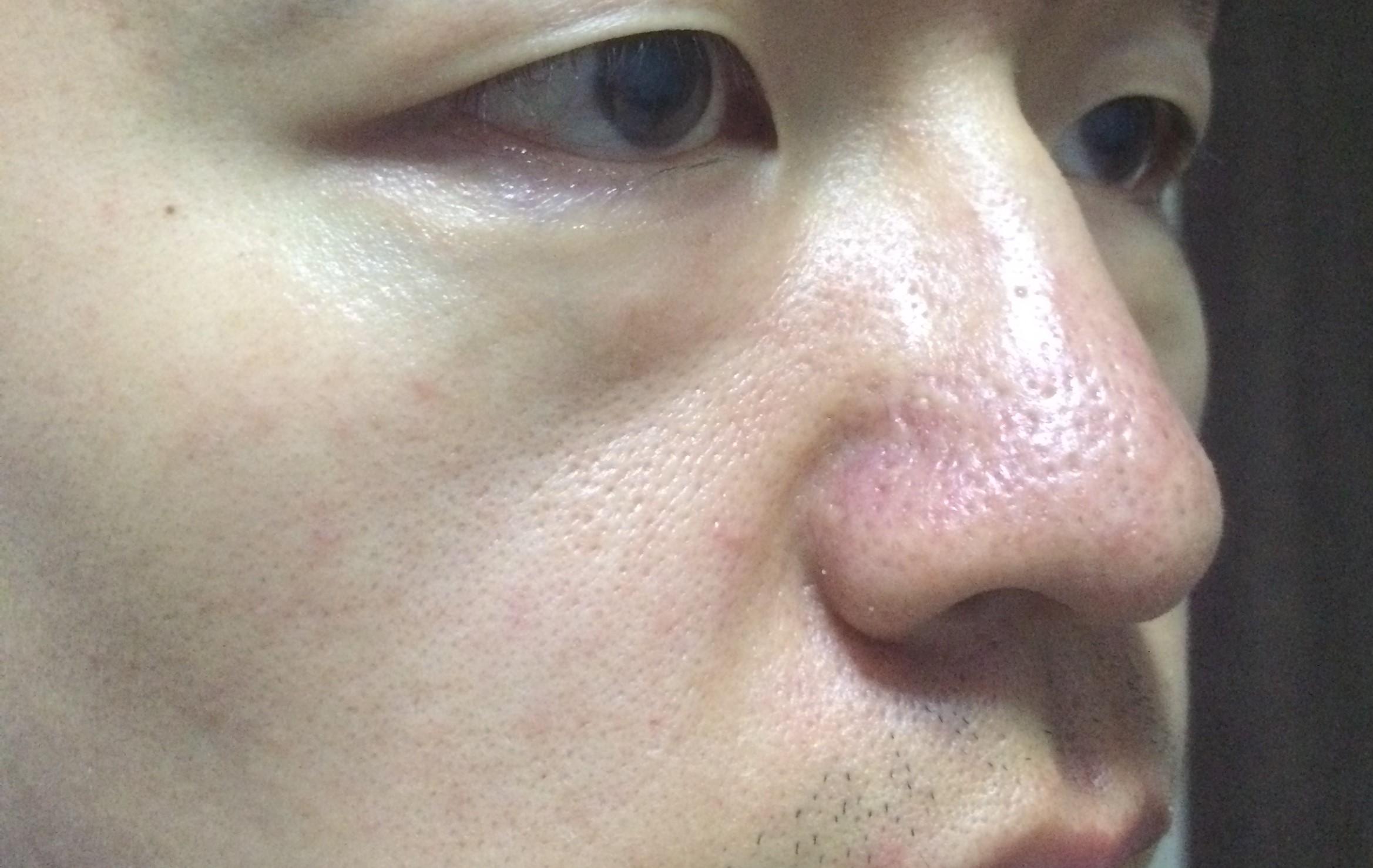 为什么皮肤会长脂栓和黑头?如何控制它们产生?