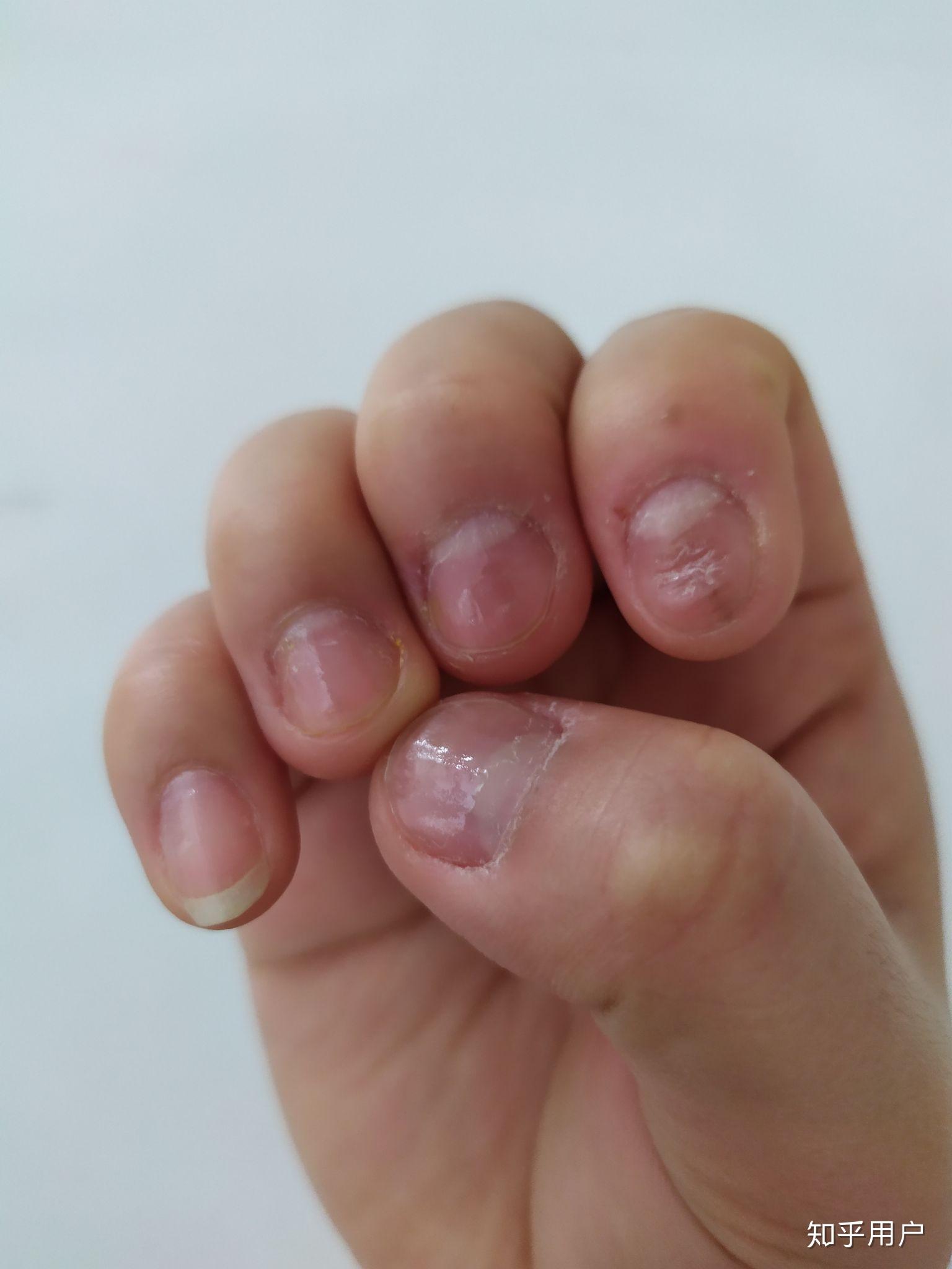 克制不住的抠手指头是心理问题吗