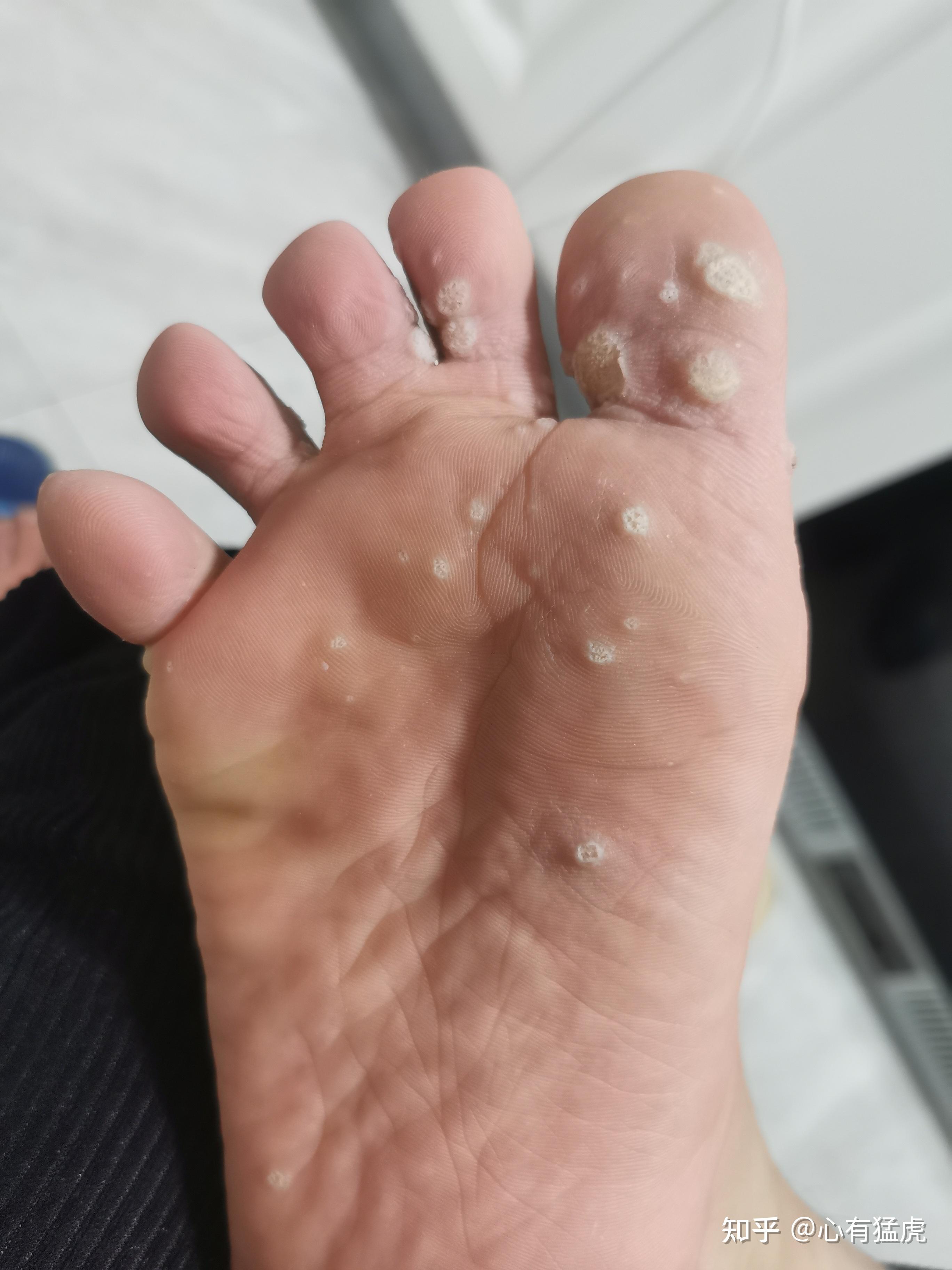 跖疣怎样有效去除