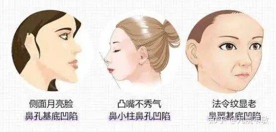 九院韦敏说，天生鼻唇沟比较深，如何改善？ - 知乎