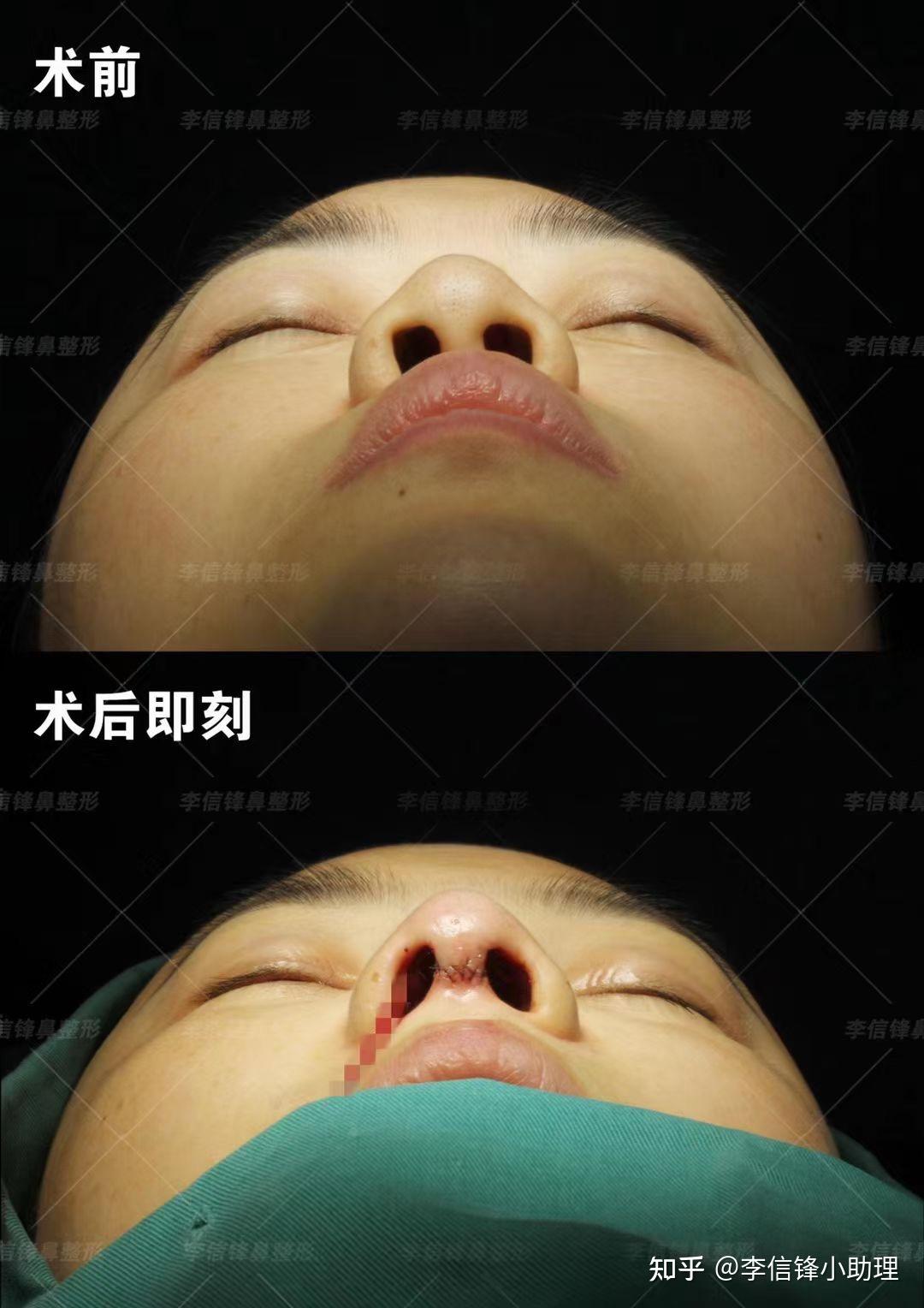 深圳隆鼻-面中部凹陷、塌鼻案例 - 知乎