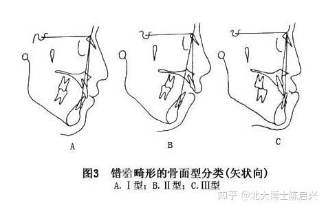 地包天的形成原因是什么?