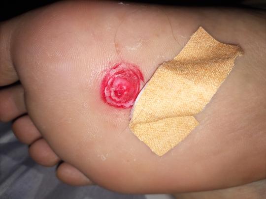 跖疣贴了鸡眼膏有什么危害