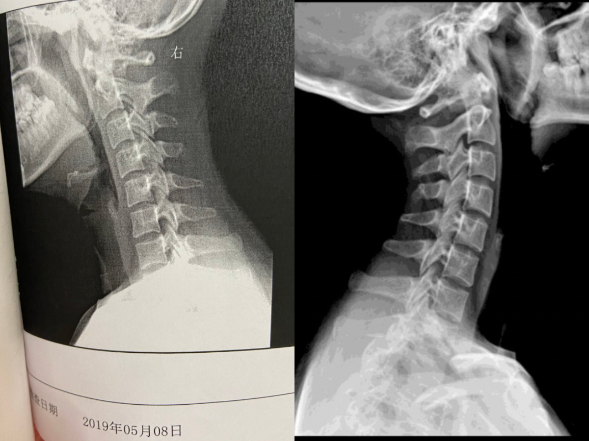 颈椎x光片正面图片