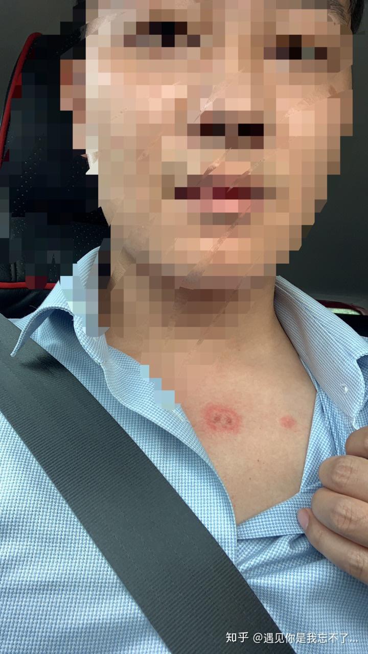 人得了猫癣发痒怎么办? - 知乎