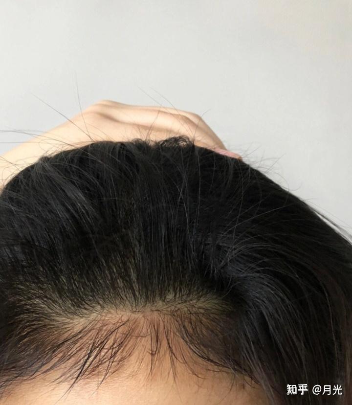 如何实现发量逆袭?育发液真的可以增加发量让头发变多吗? - 知乎