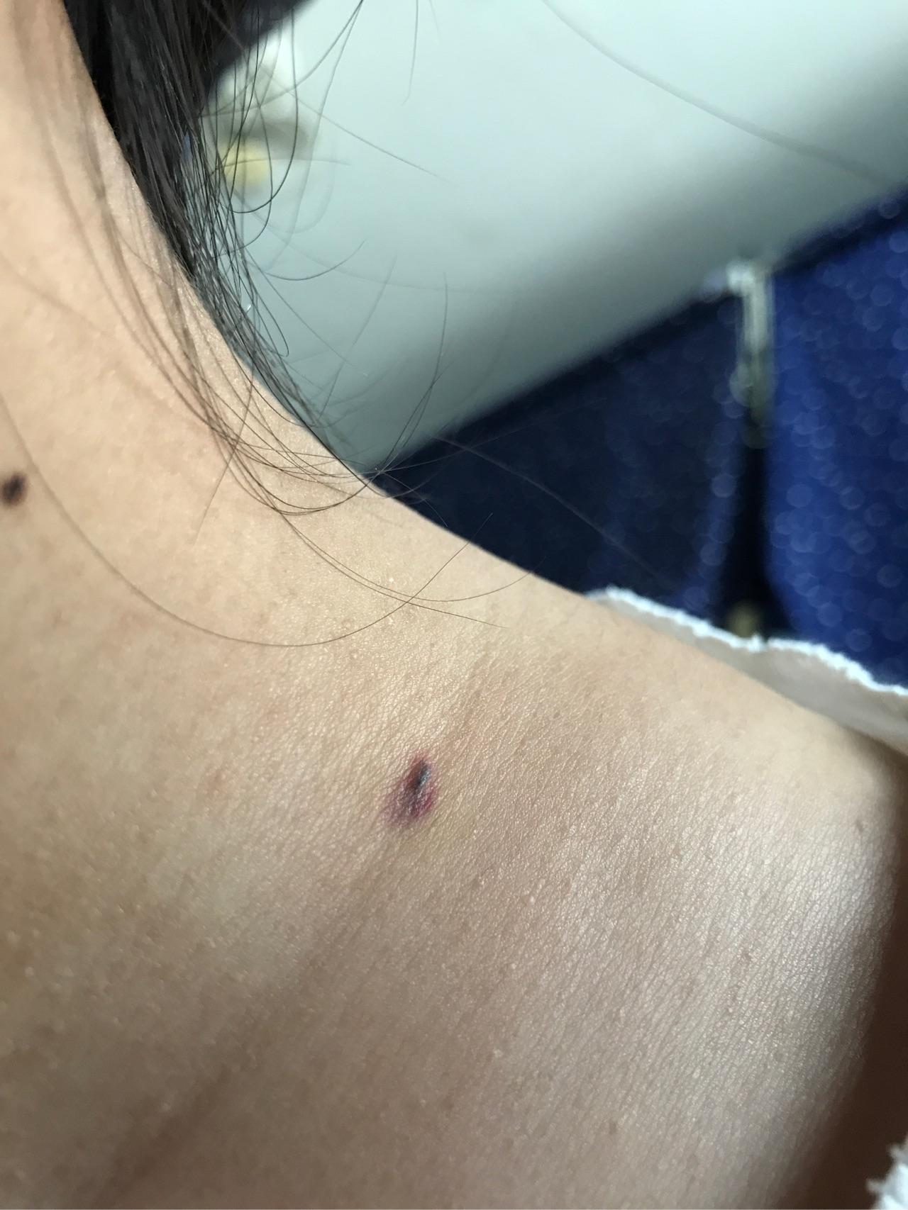 身上的黑色肉痣突然流血不止