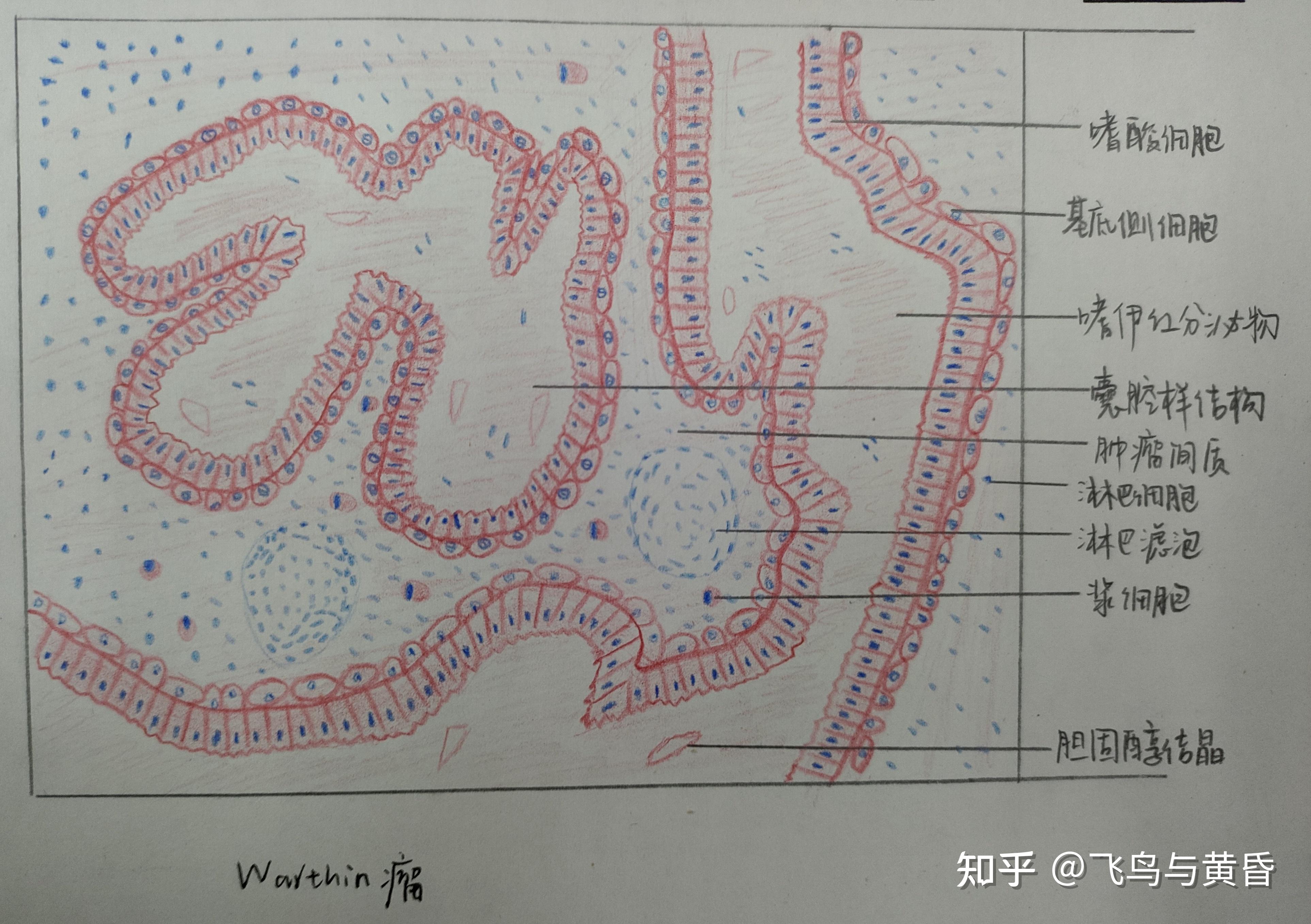 warthin瘤红蓝铅笔图