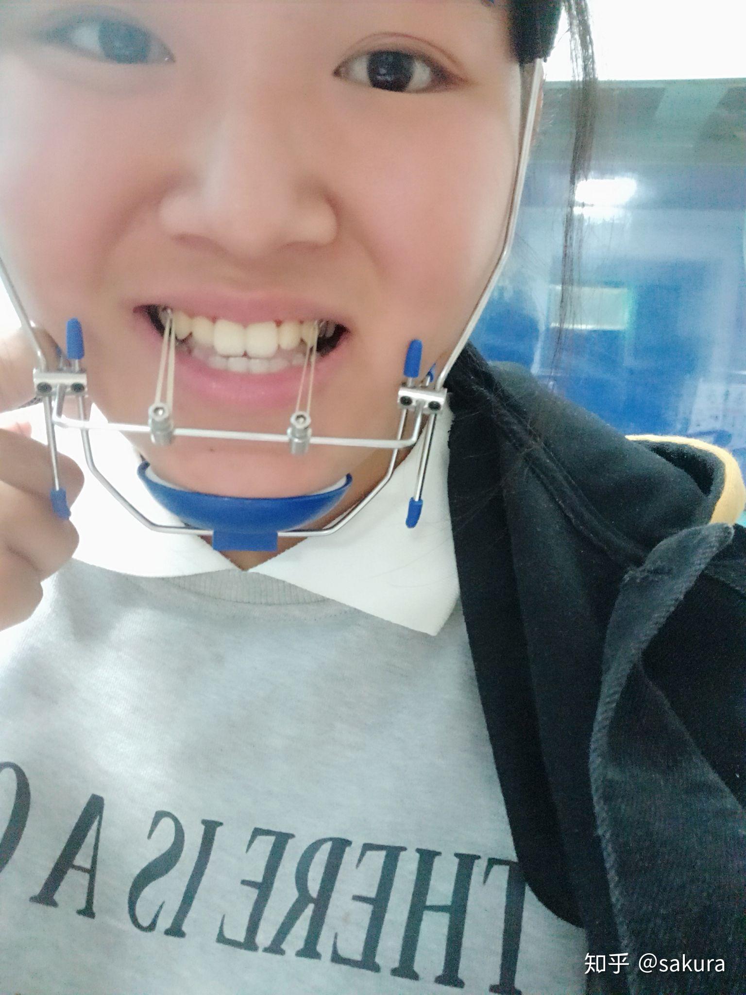 有没有治疗反颌(地包天)戴过矫治器 面框的人呀? - 知乎