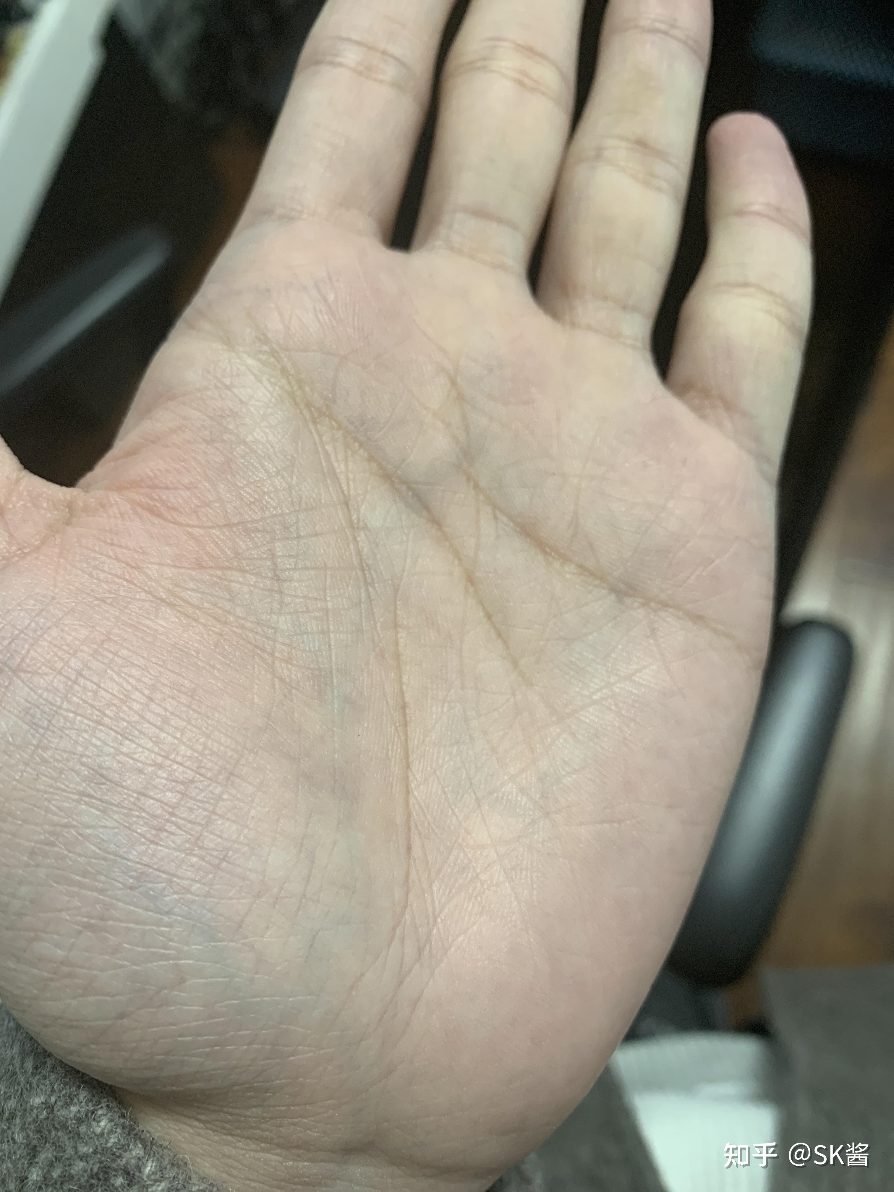 手腕上静脉颜色很明显是身体有什么病症的原因吗