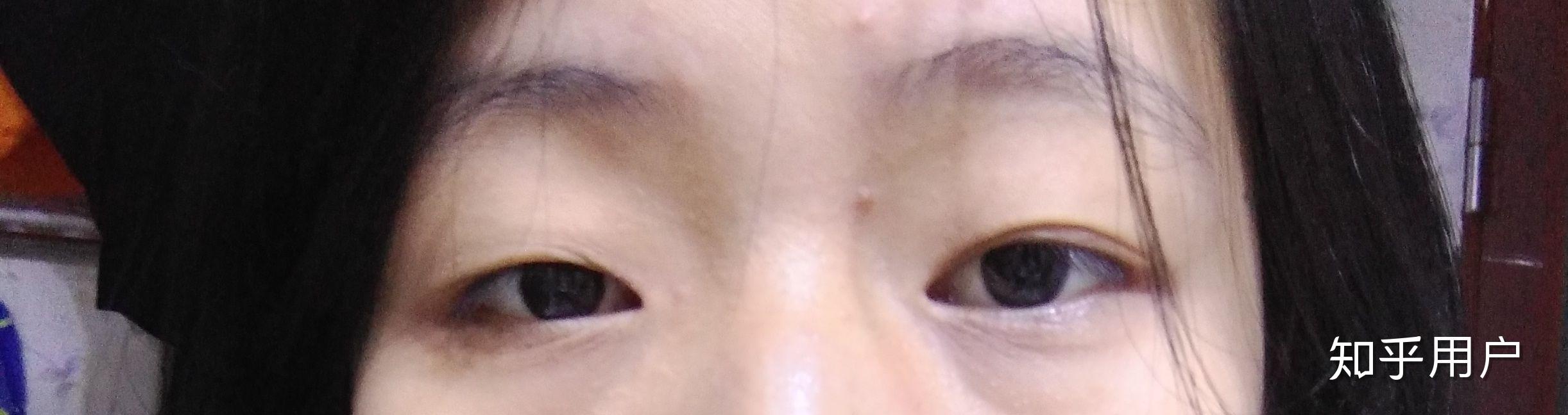 我想请问各位大佬,我的眼睛一大一小,一单一双,怎么可以整为一样大的!
