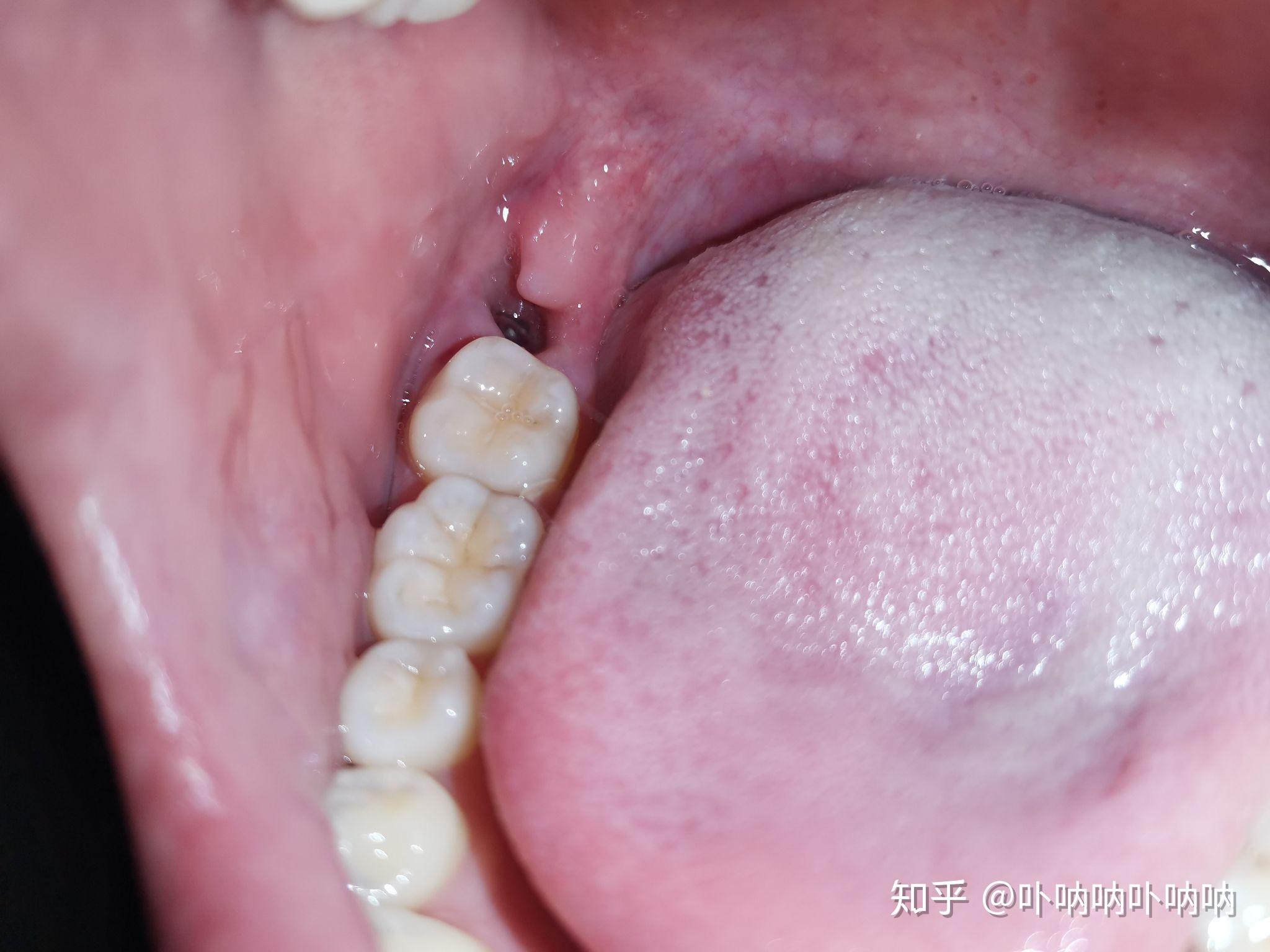 为什么大部分人会长智齿而有些人不长智齿?长智齿有何利弊?