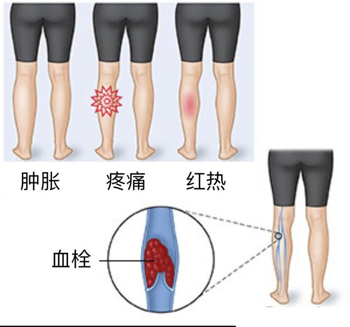 静脉血栓是如何形成的，有何危害？ 知乎
