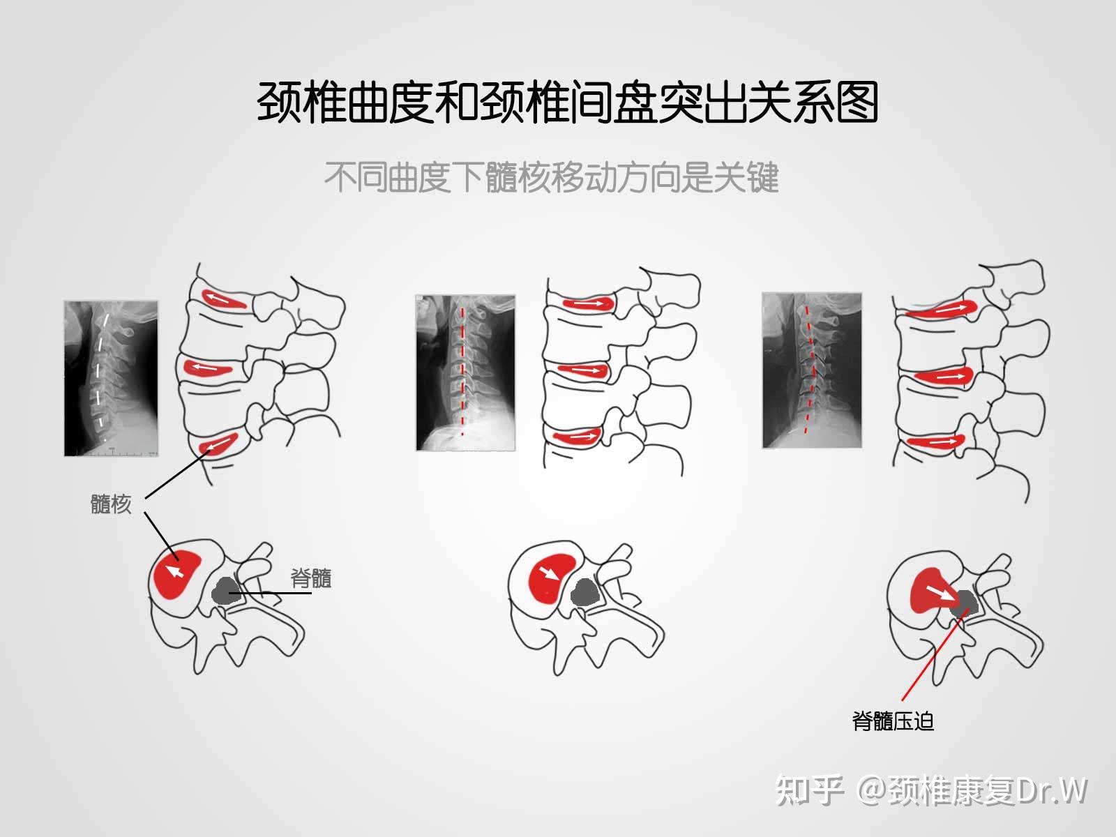 为什么会得颈椎反弓