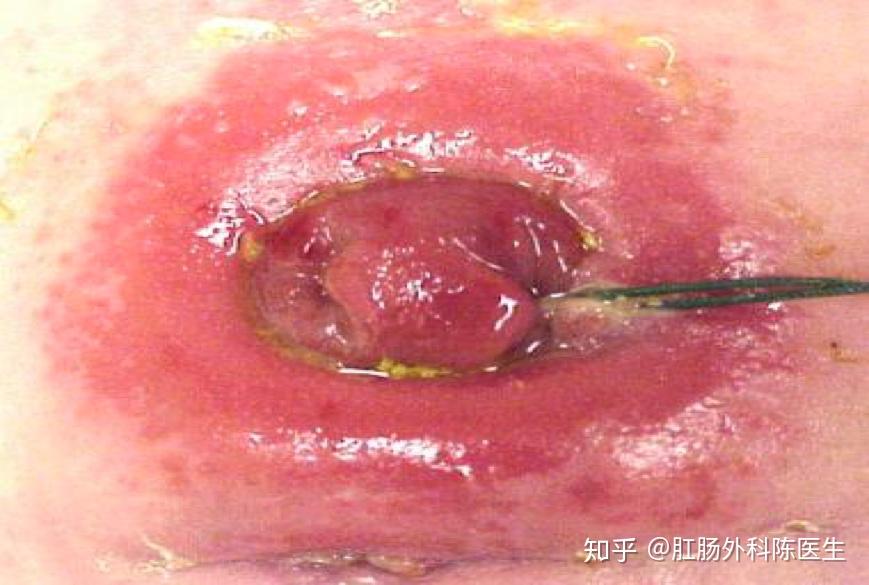 为什么说造口形态变化是造口渗漏的重要原因