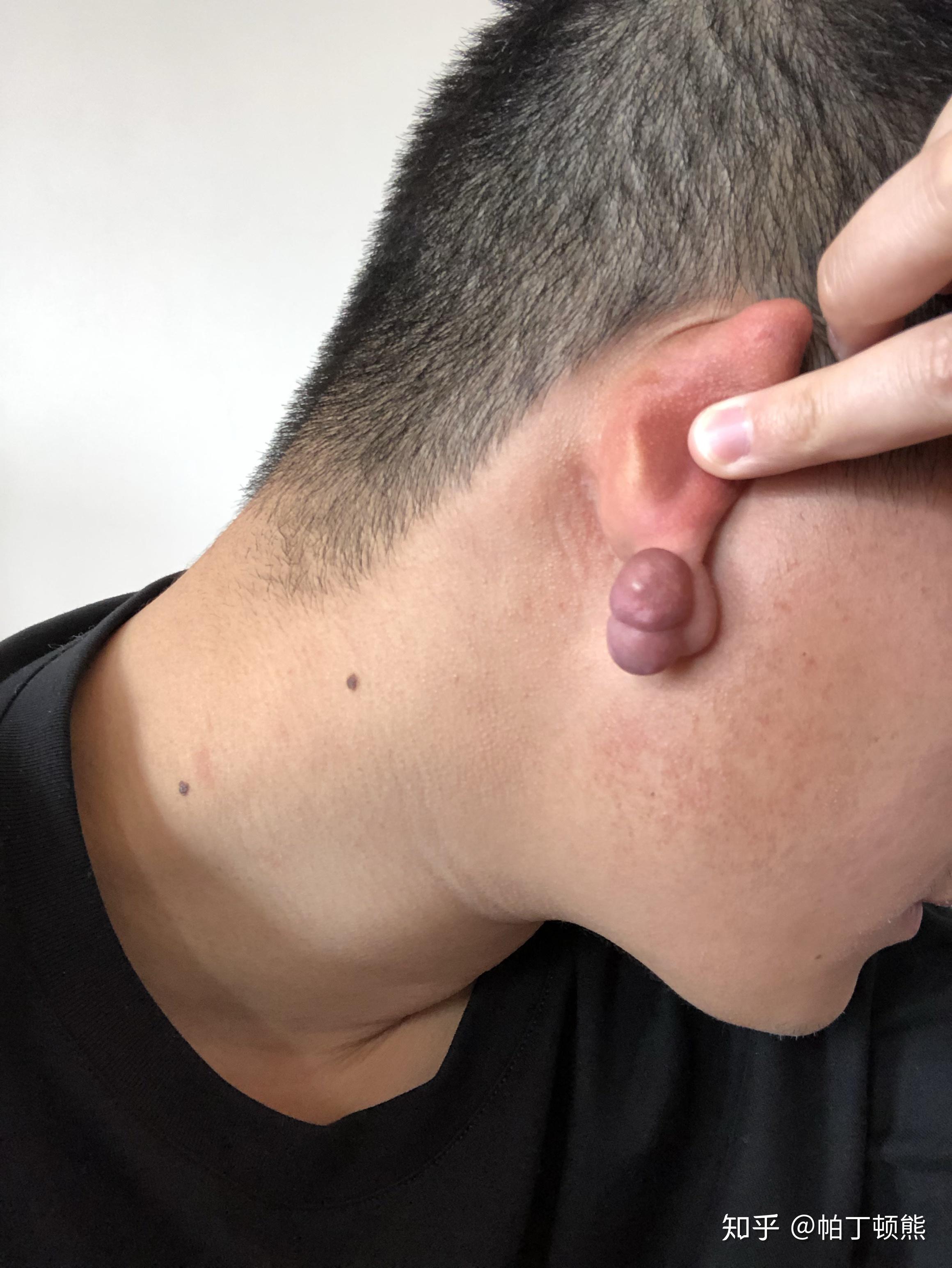 耳朵瘢痕疙瘩切除手术整个下来大概多少钱