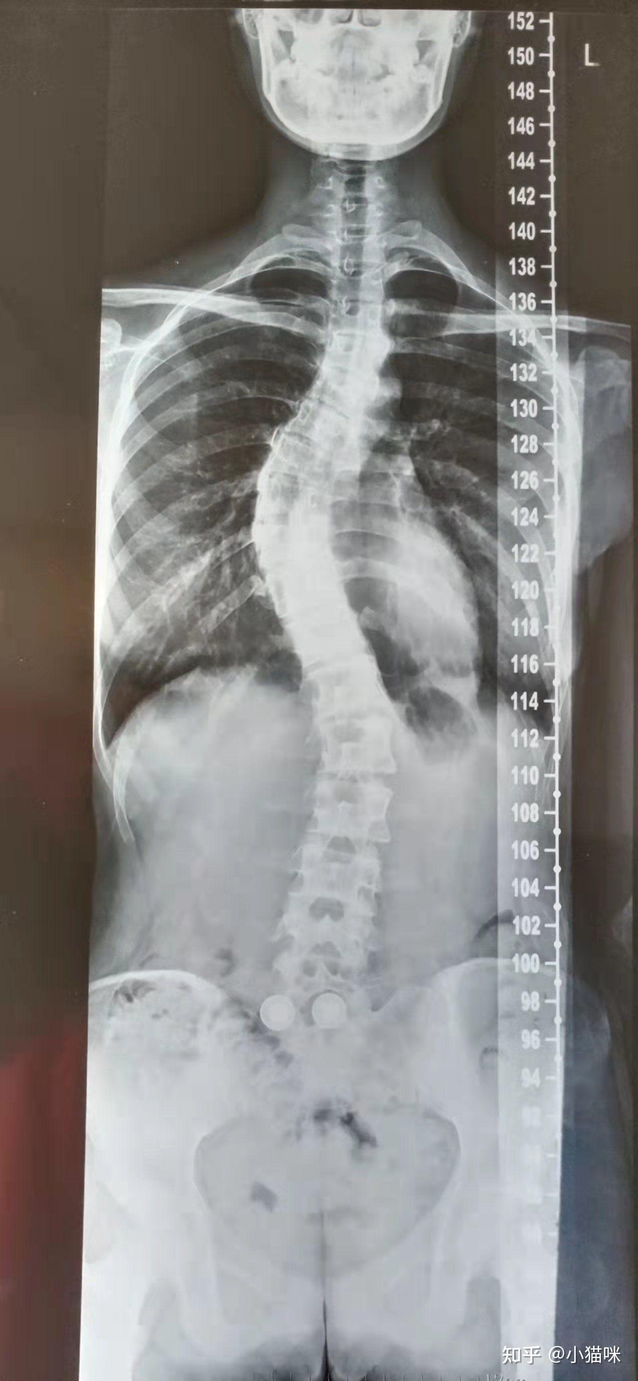 胸椎侧弯希望专业人士解答一下