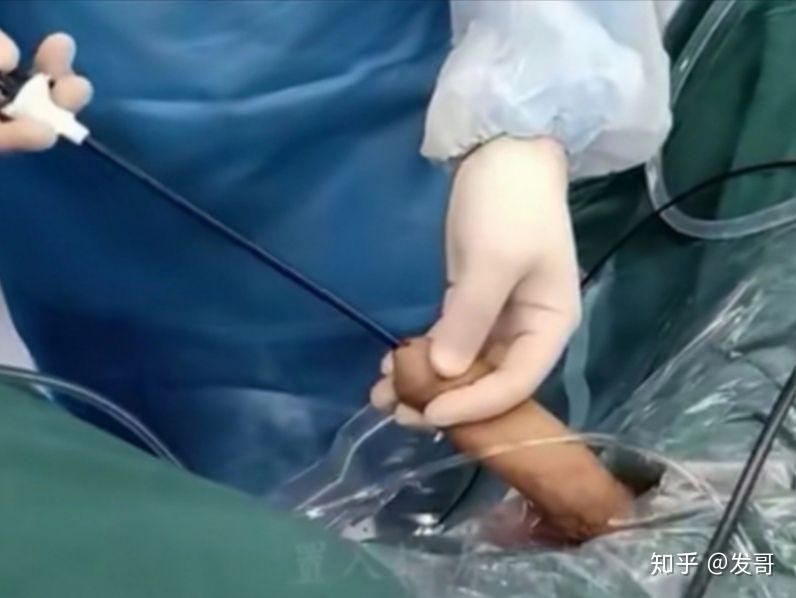 有做过经肾结石尿道输尿管软镜碎石手术的吗?求经验经历分享.