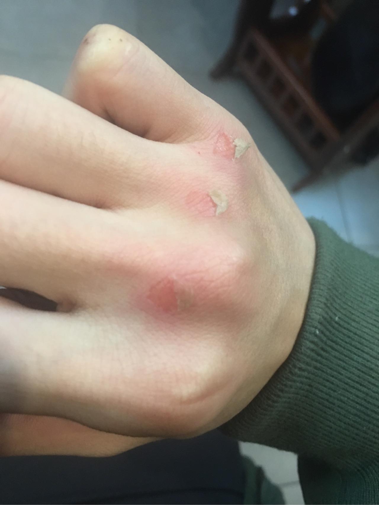 大家的拳茧都啥样了想见见