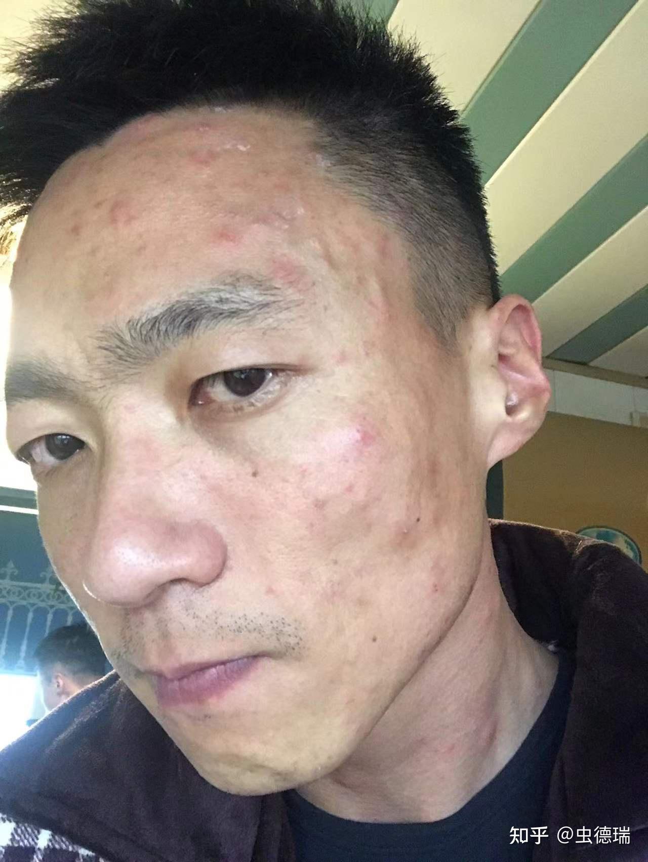 为什么成人得水痘后会更严重致死率也更高