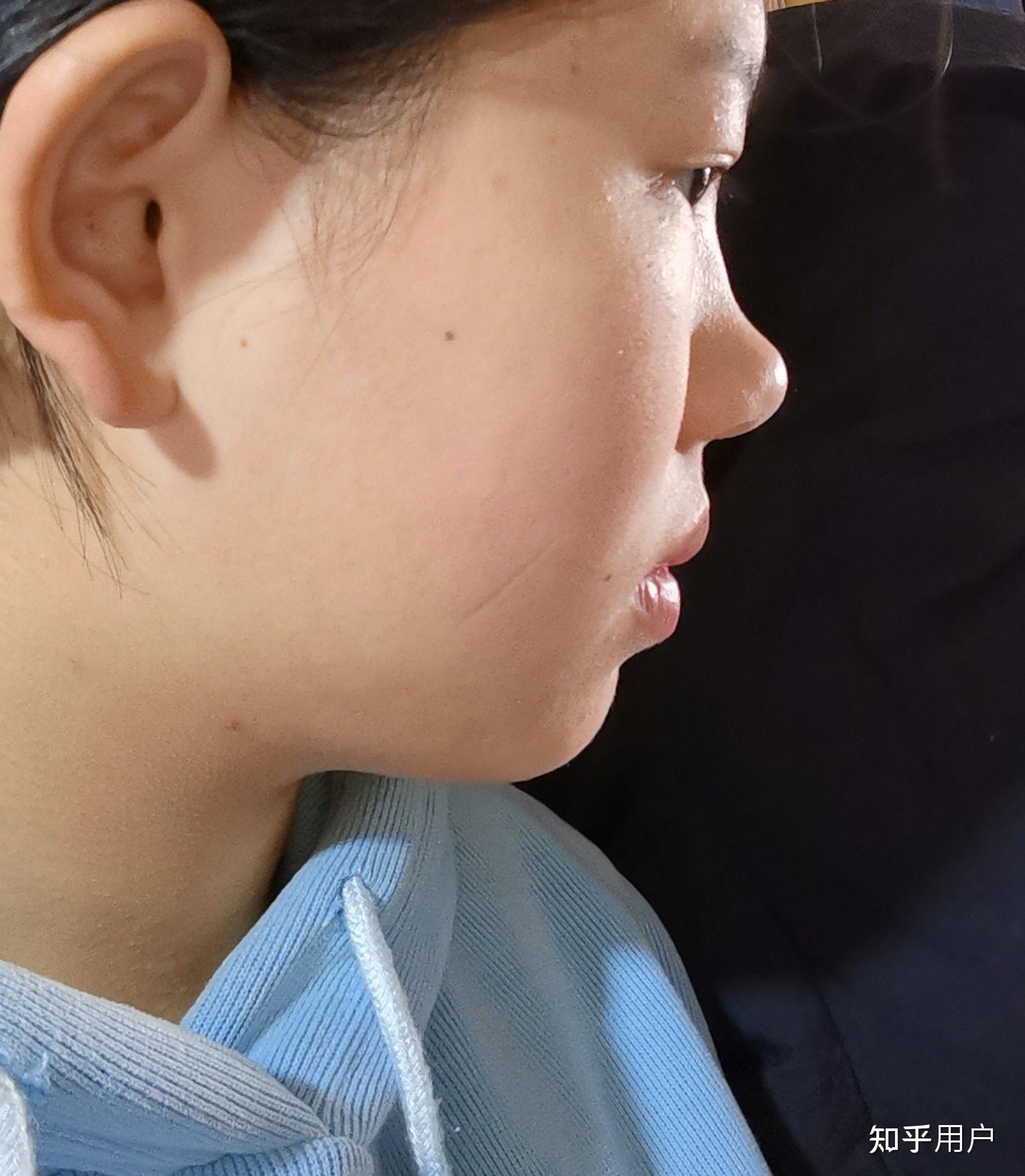 没有鼻梁,鼻子塌的人是什么体验? - 知乎
