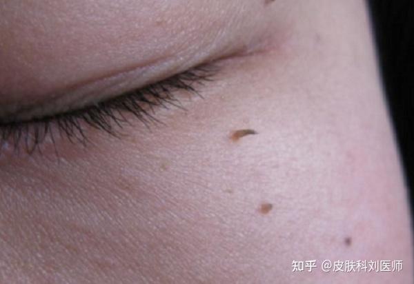 脖子、眼周突然冒出的小尖肉刺,你还不知道是丝状疣? - 知乎
