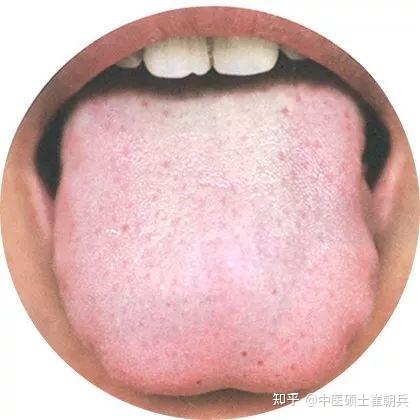 史上最全高清舌诊图谱,堪比教科书(收藏篇) - 知乎