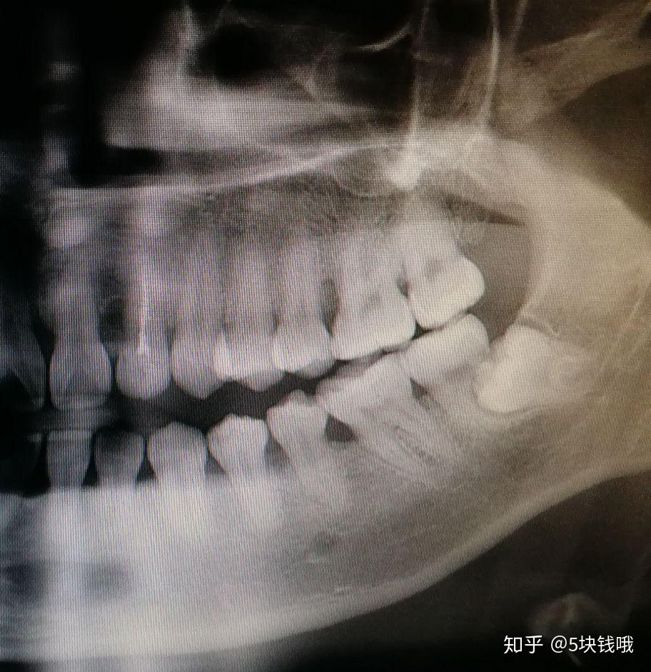 阻生齒看著就嚇人一直都不敢去拔最近同事和我分享她的拔水平智齒的