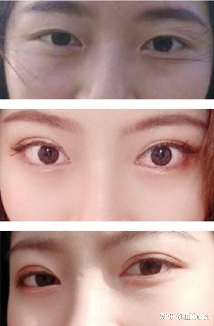 上海双眼皮眼王是谁? - 知乎