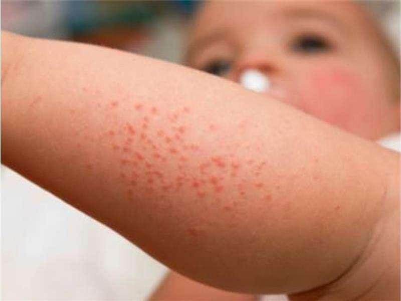 宝宝反复湿疹怎么护理?