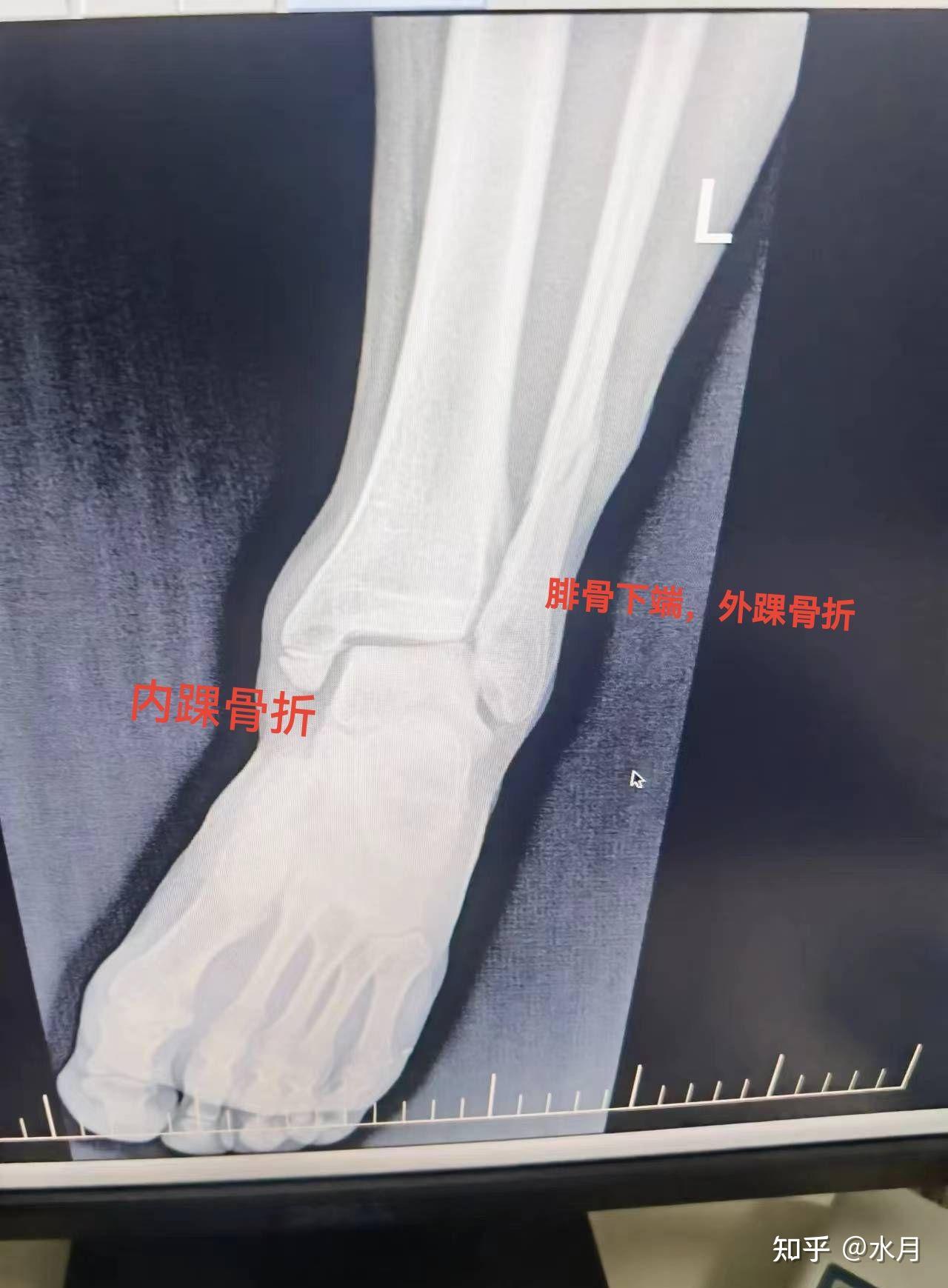 三踝骨折的发生、治疗与康复- 知乎