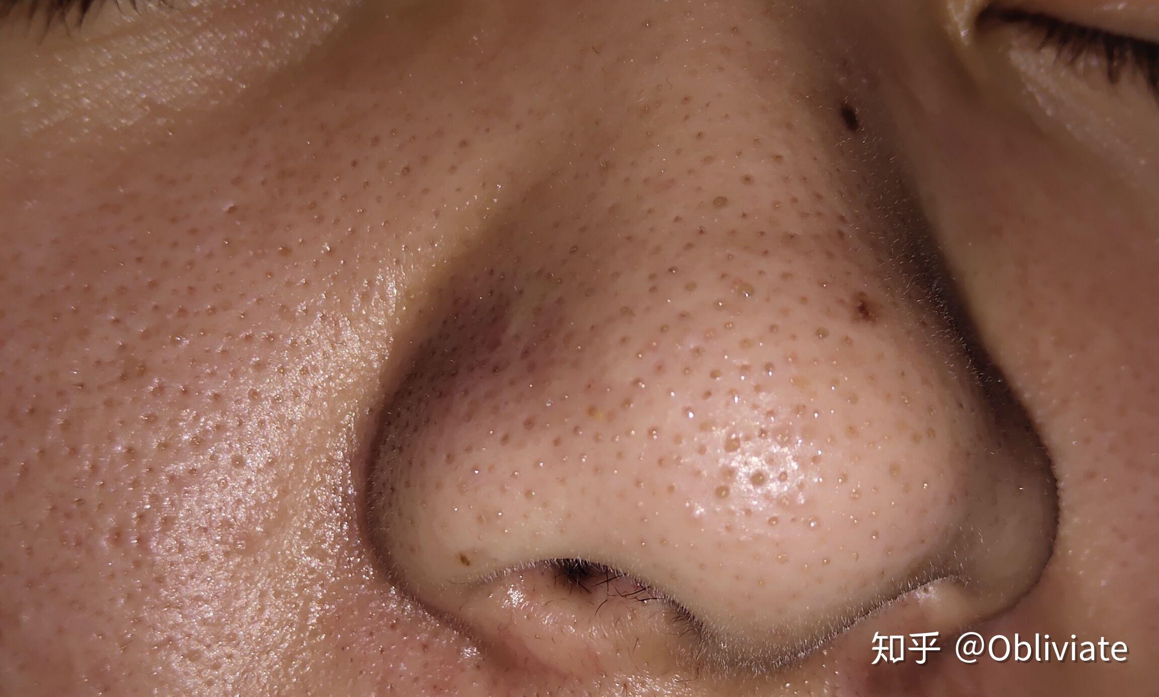 毳毛黑头怎么去呀? - 知乎