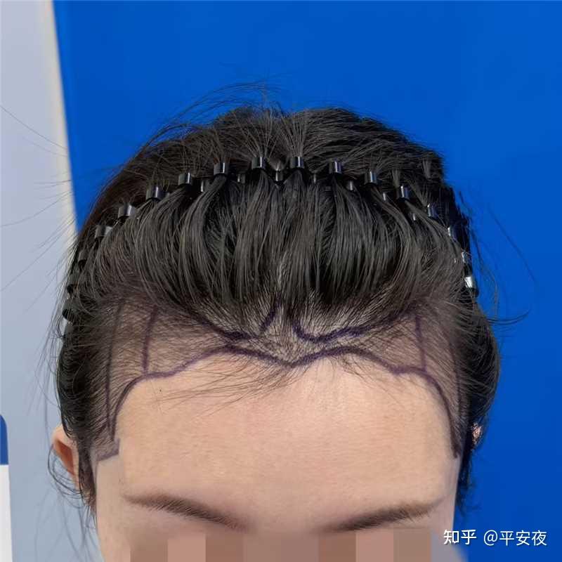 女生不剃发植发5天!1900单位花瓣形发际线,弧度能更自然吗? - 知乎