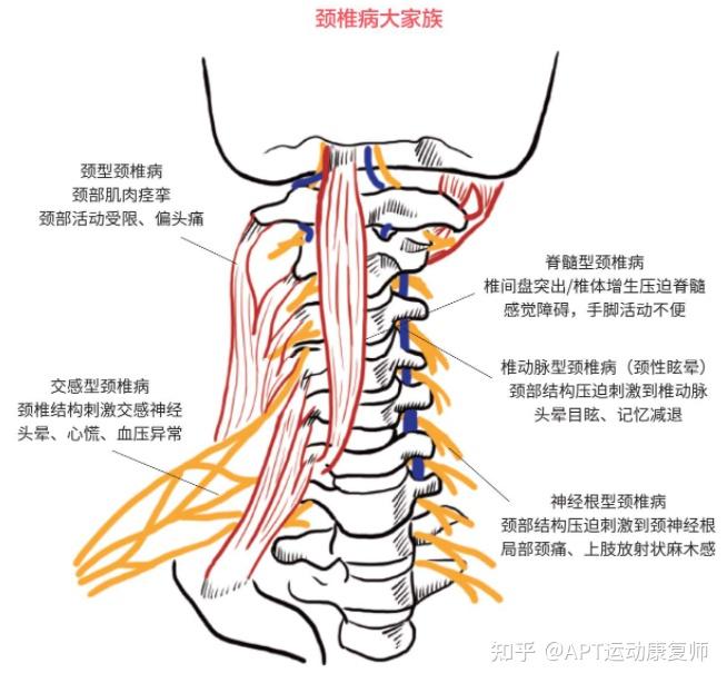 精选案例|脊髓型颈椎病保守治疗,12次康复解除神经压迫 - 知乎