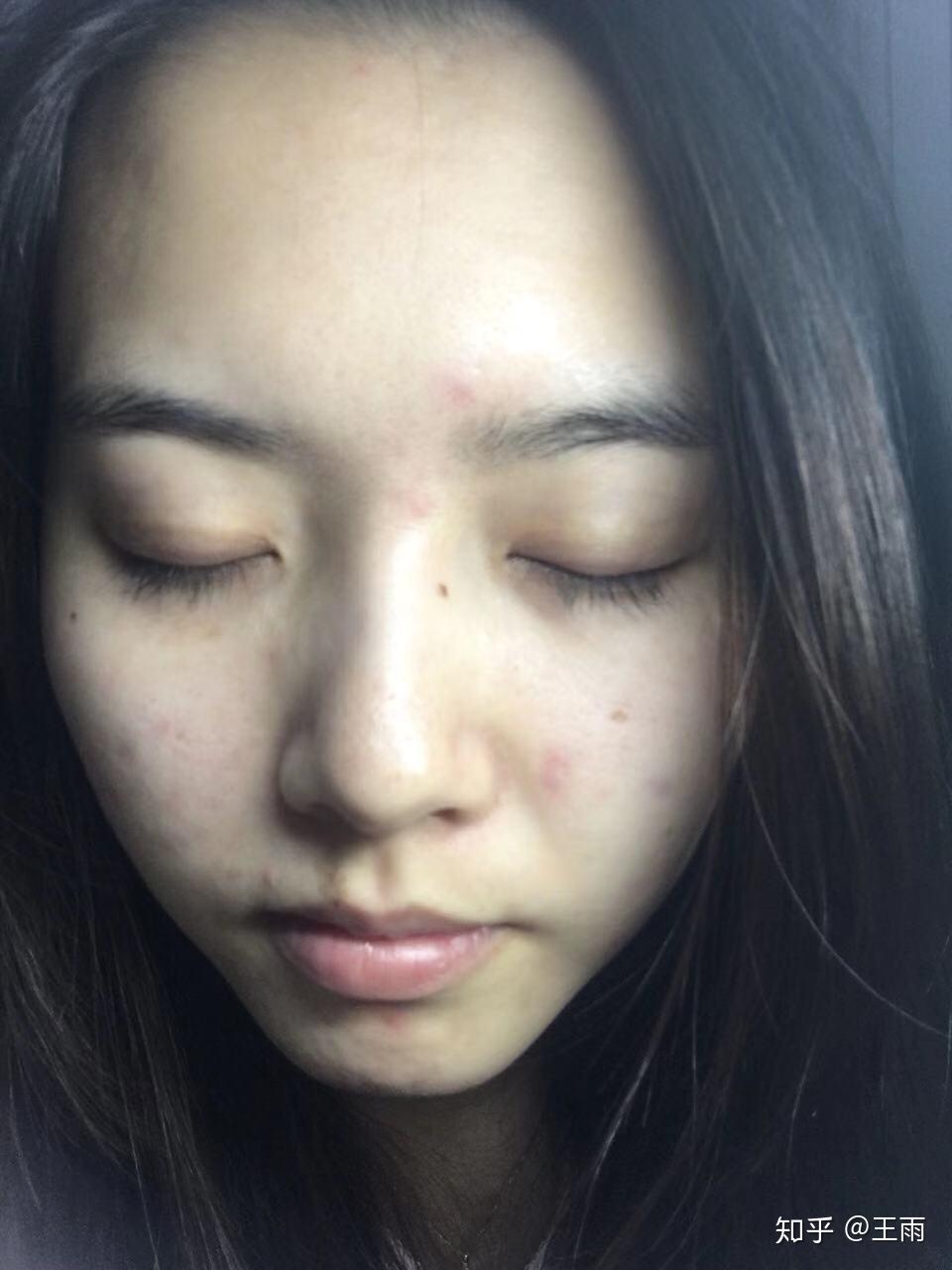 眉心长痘痘怎么回事啊两个眉毛之间的三角区总是冒痘怎么回事