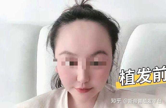植发哪里有治(植发去哪里正规)