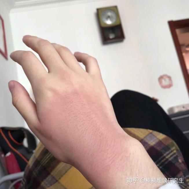 手被开水烫伤了怎么办