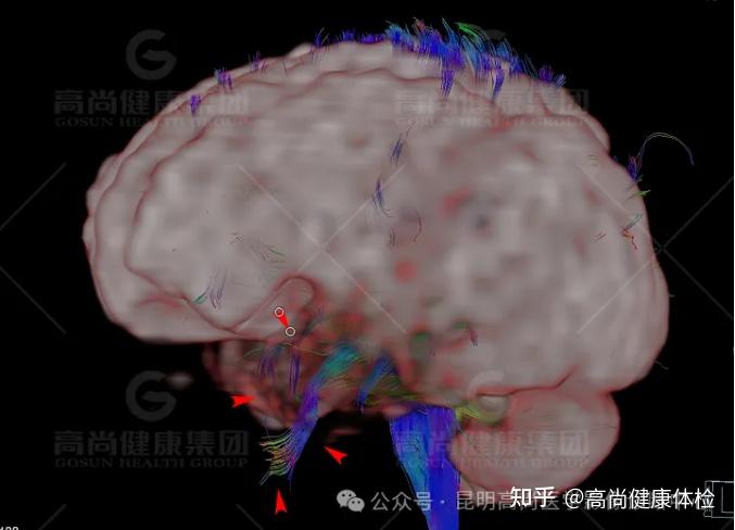 PET/CT-MR联合显像寻找致痫灶一例 - 知乎