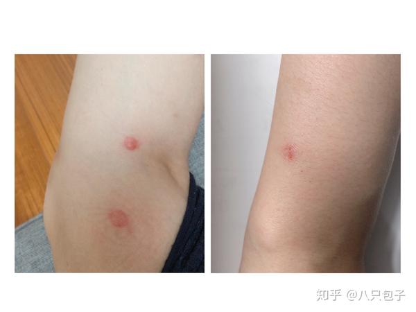 猫身上的跳蚤(虫子)咬人,该怎样解决?