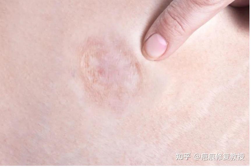 几种常见的疤痕类型,你属于哪种? - 知乎