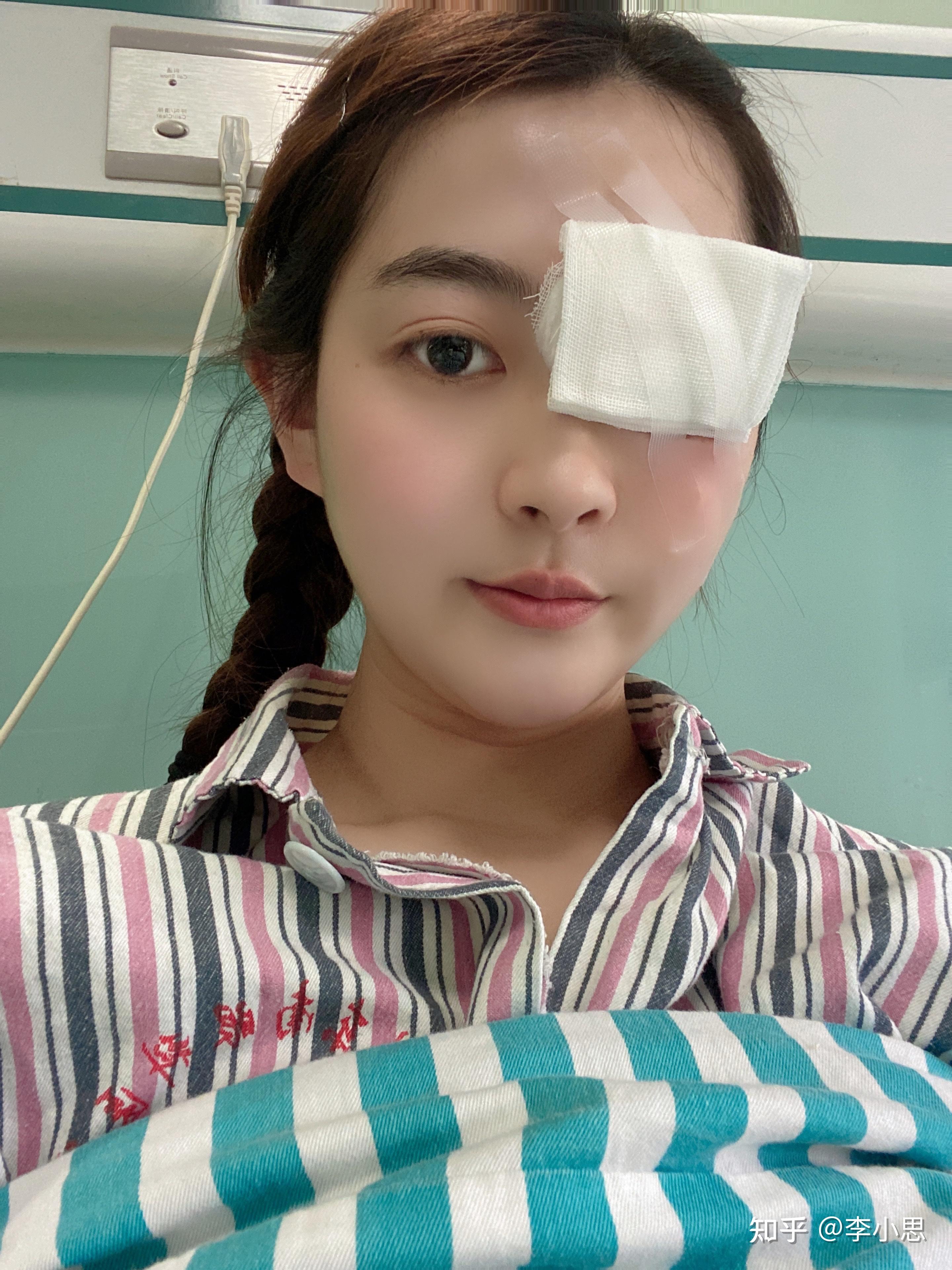 吃糖皮质激素引起的满月脸可以完全恢复吗? - 知乎