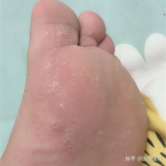 水皰型腳氣水泡能扎破嗎