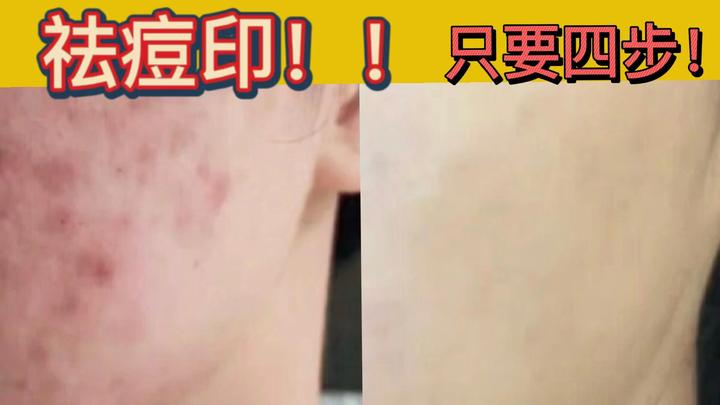 祛痘印成功!满脸痘印逆袭干净无暇的好皮肤!便宜去痘印产品,学生党不容错过!(附详细使用方法) - 知乎