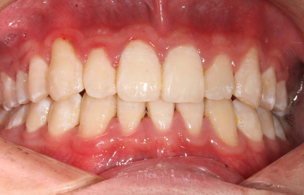 牙齿正畸需要拔掉4颗牙齿之后只剩下24颗牙齿这样正常吗