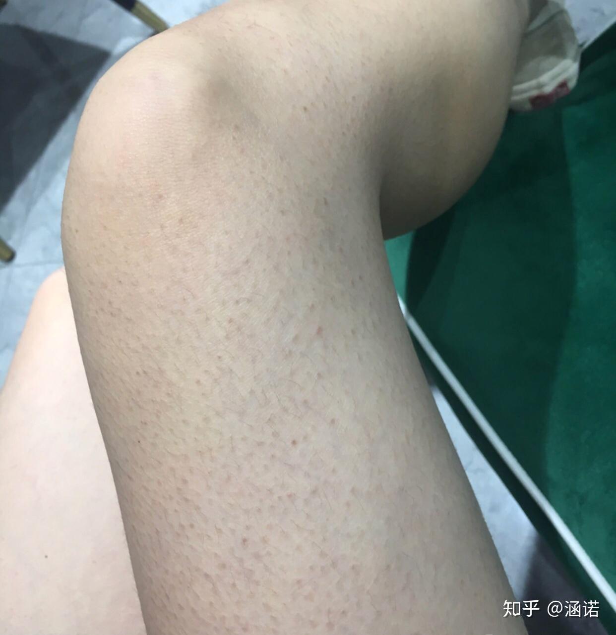 一般鸡皮肤怎么解决的简单介绍