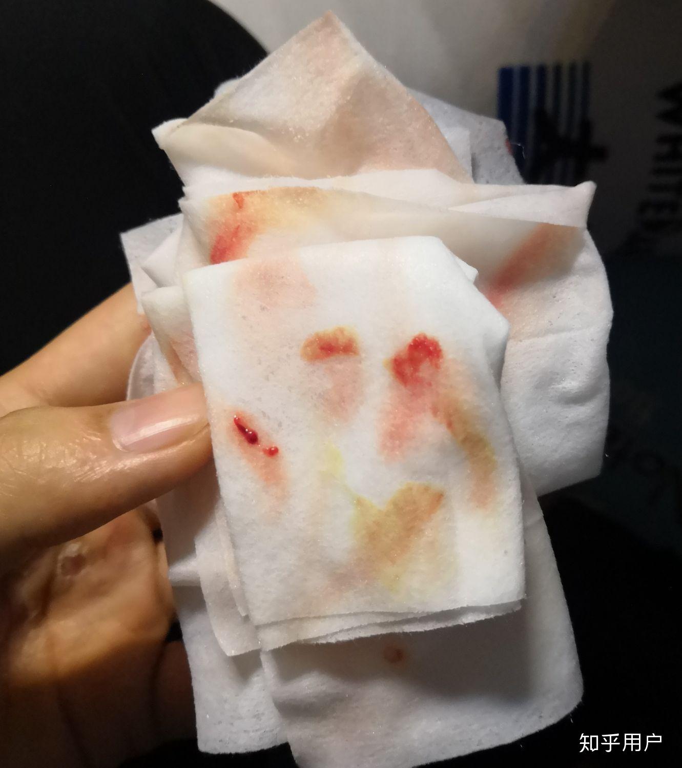 请问屁股上长了火疖子该怎么办